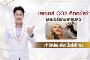 เลเซอร์ CO2