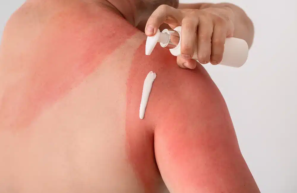 วิธีบรรเทาอาการแสบร้อนจากผิวไหม้แดดด้วยตัวเอง