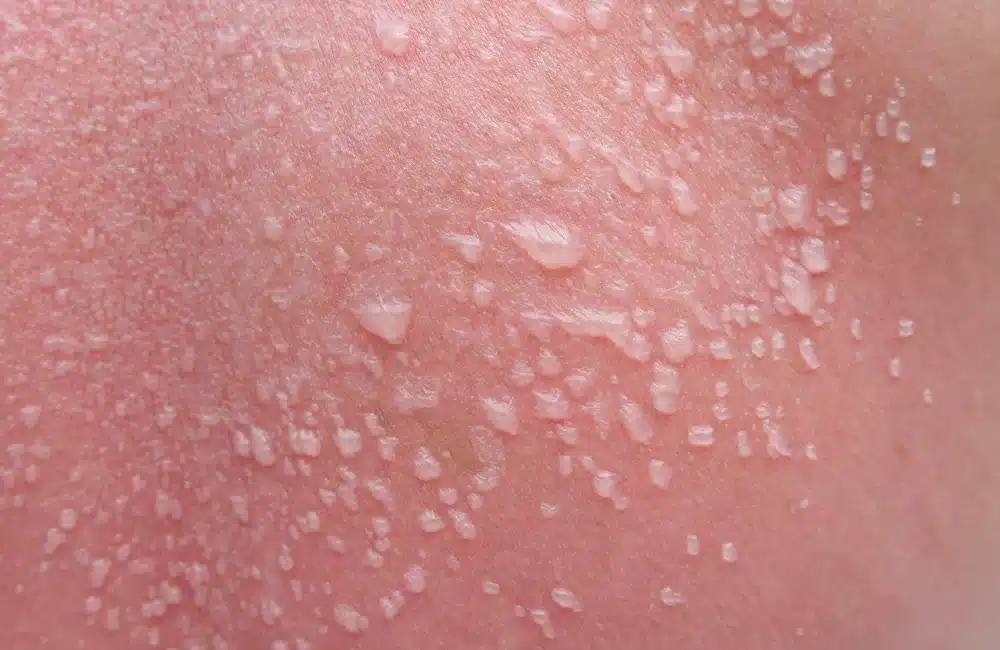 สัญญาณอันตราย! อาการผิวไหม้แดดแบบไหนที่ควรรีบปรึกษาแพทย์