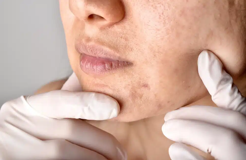 สิววัยทอง ต่างจากสิววัยรุ่นอย่างไร