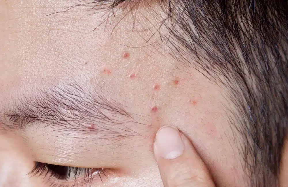 สาเหตุหลักที่ทำให้เกิดรูขุมขนอักเสบ