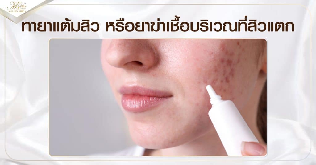 ทายาแต้มสิว หรือยาฆ่าเชื้อบริเวณที่สิวแตก