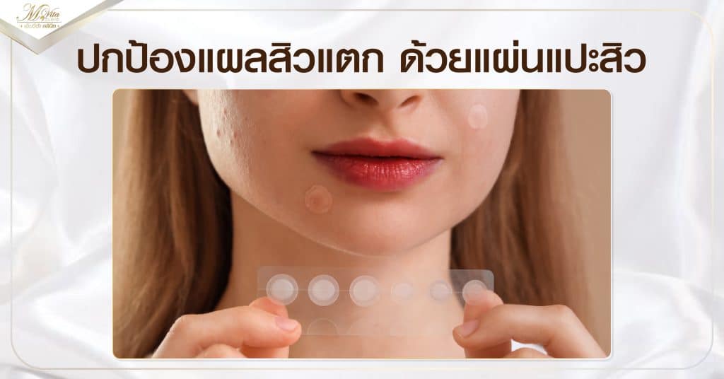ปกป้องแผลสิวแตก ด้วยแผ่นแปะสิว