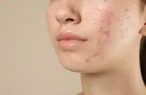 การทำเลเซอร์รอยสิว ราคาเท่าไหร่