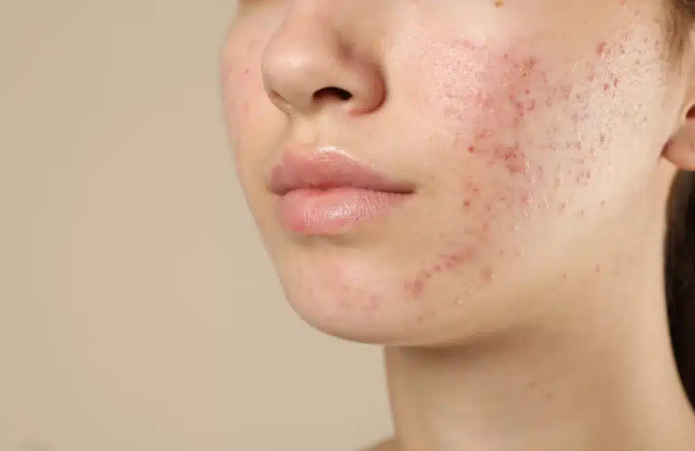 การทำเลเซอร์รอยสิว ราคาเท่าไหร่