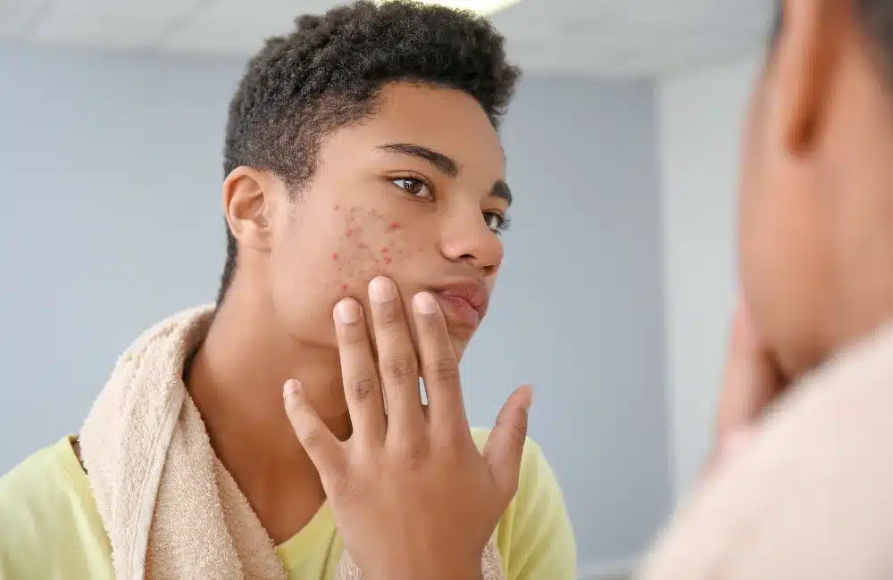 รู้จักกับสิวฮอร์โมนชาย เกิดจาดอะไร มีวิธีการรักษาอย่างไร ไม่ให้กลับมาเป็นซ้ำ