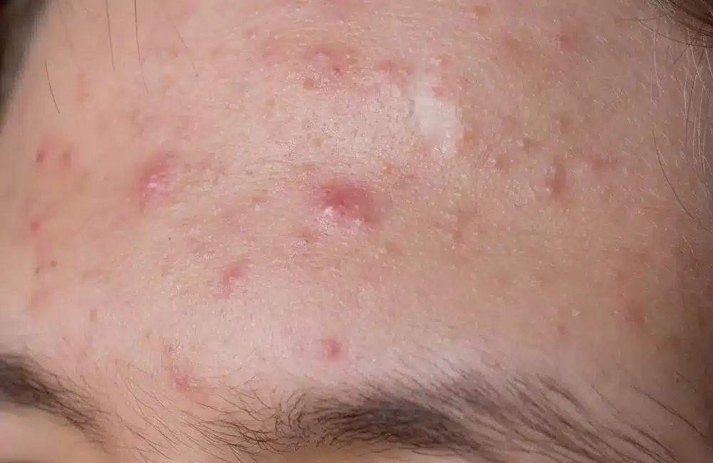 อาการขาด Zinc