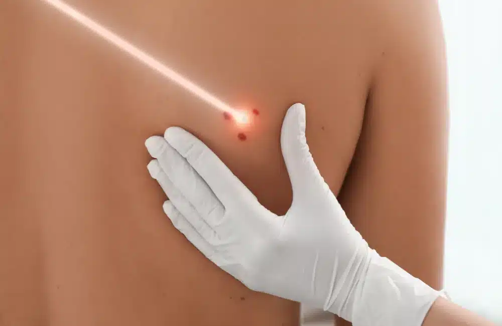 การรักษาปานแดง