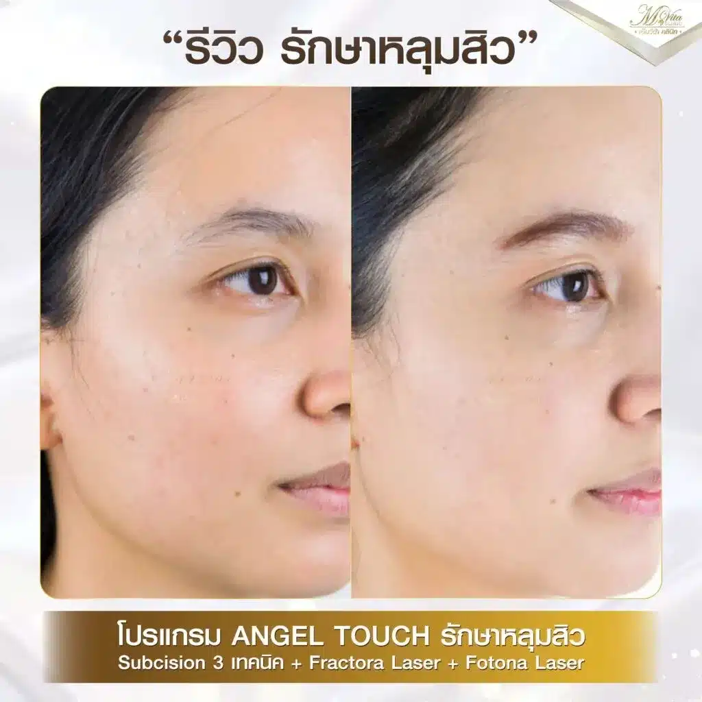 imgi_21_รีวิว-รักษาหลุมสิว-คุณไพลิน-1024x1024-1.webp