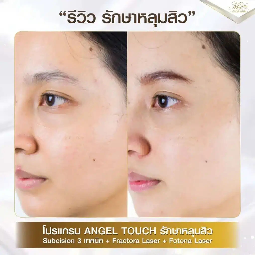 imgi_22_รีวิว-เลเซอร์รักษาหลุมสิว-คุณไพลิน-1024x1024-1.webp