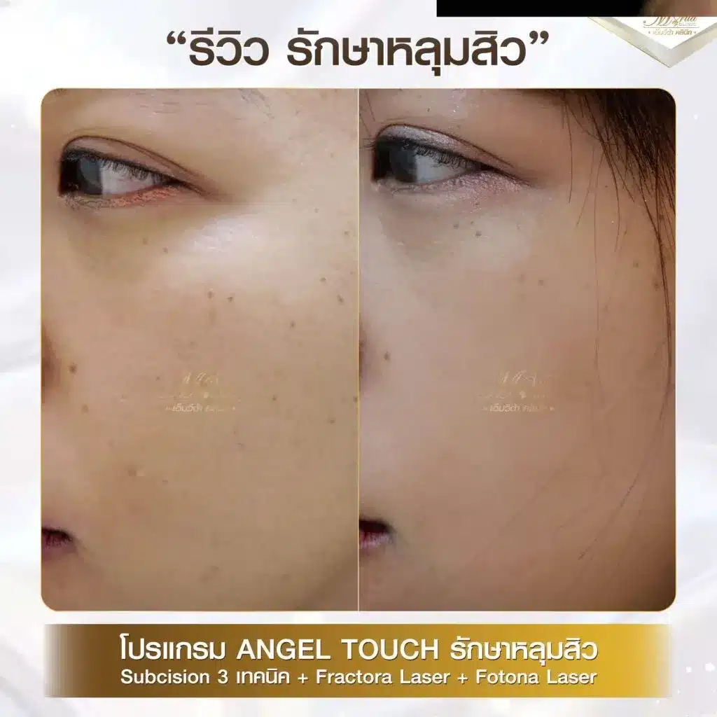 imgi_26_รีวิว-หลุมสิว-คุณเมย์-1024x1024-1.webp