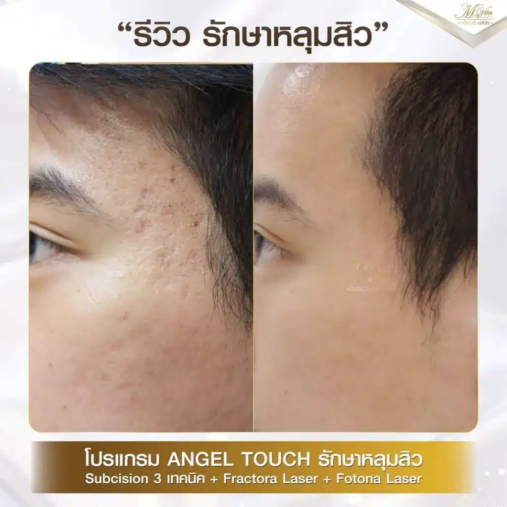 imgi_29_รีวิว-รักษาหลุมสิว-คุณฮิม-1024x1024-1.webp