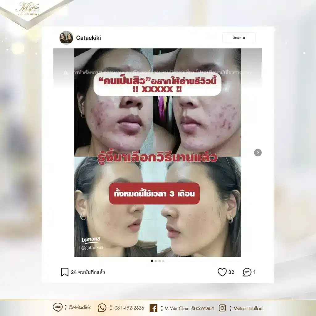 รักษาสิวไม่ทานยา-รีวิว-01-1024x1024