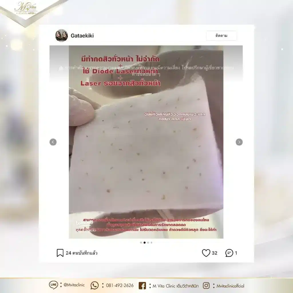 รักษาสิวไม่ทานยา-รีวิว-2-01-1024x1024