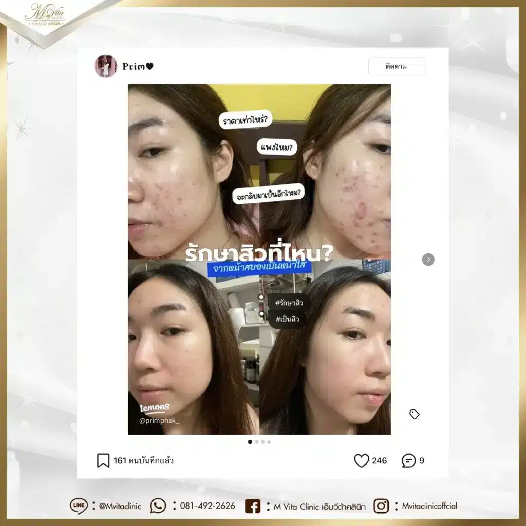 รีวิว-คลินิกรักษาสิว-จาก-น้องพริม-01-1024x1024