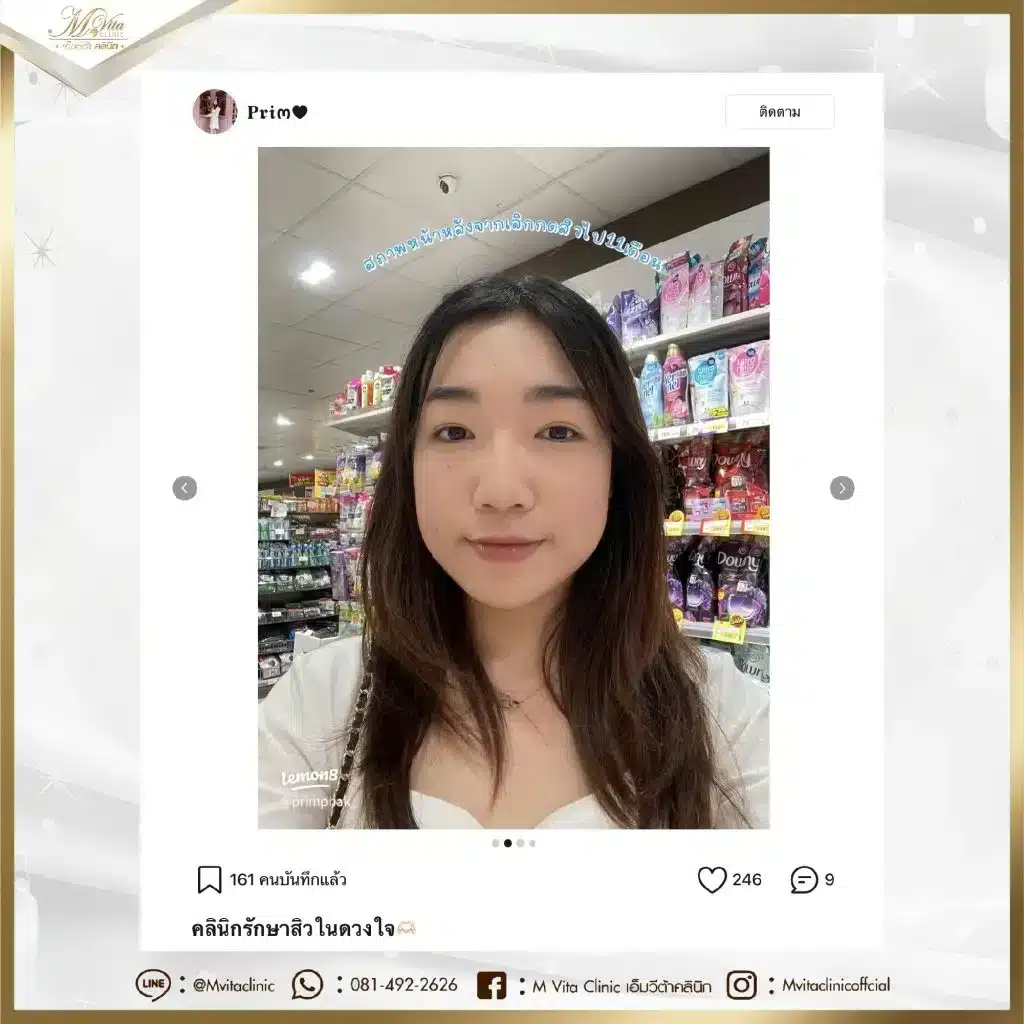 รีวิว-คลินิกรักษาสิว-จาก-น้องพริม-02-1024x1024