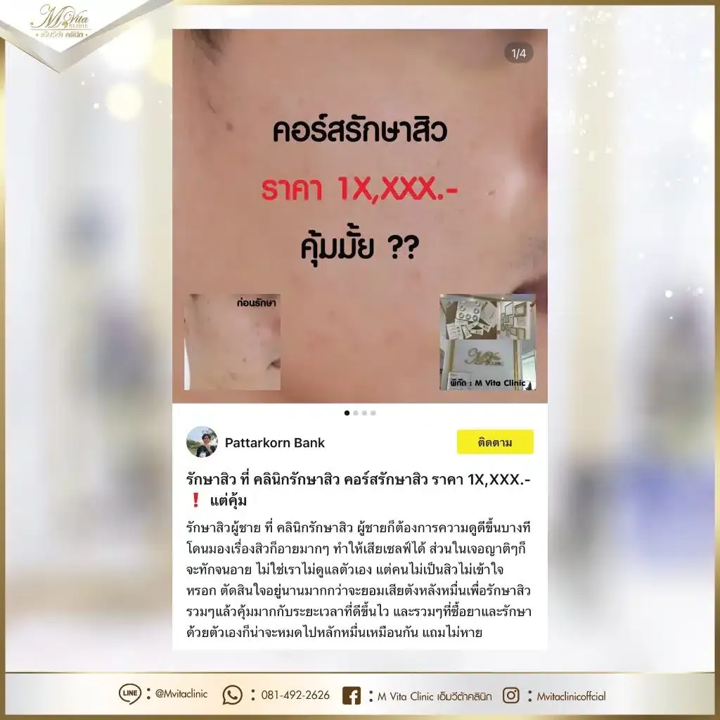 รีวิว-รักษาสิว-1-1024x1024