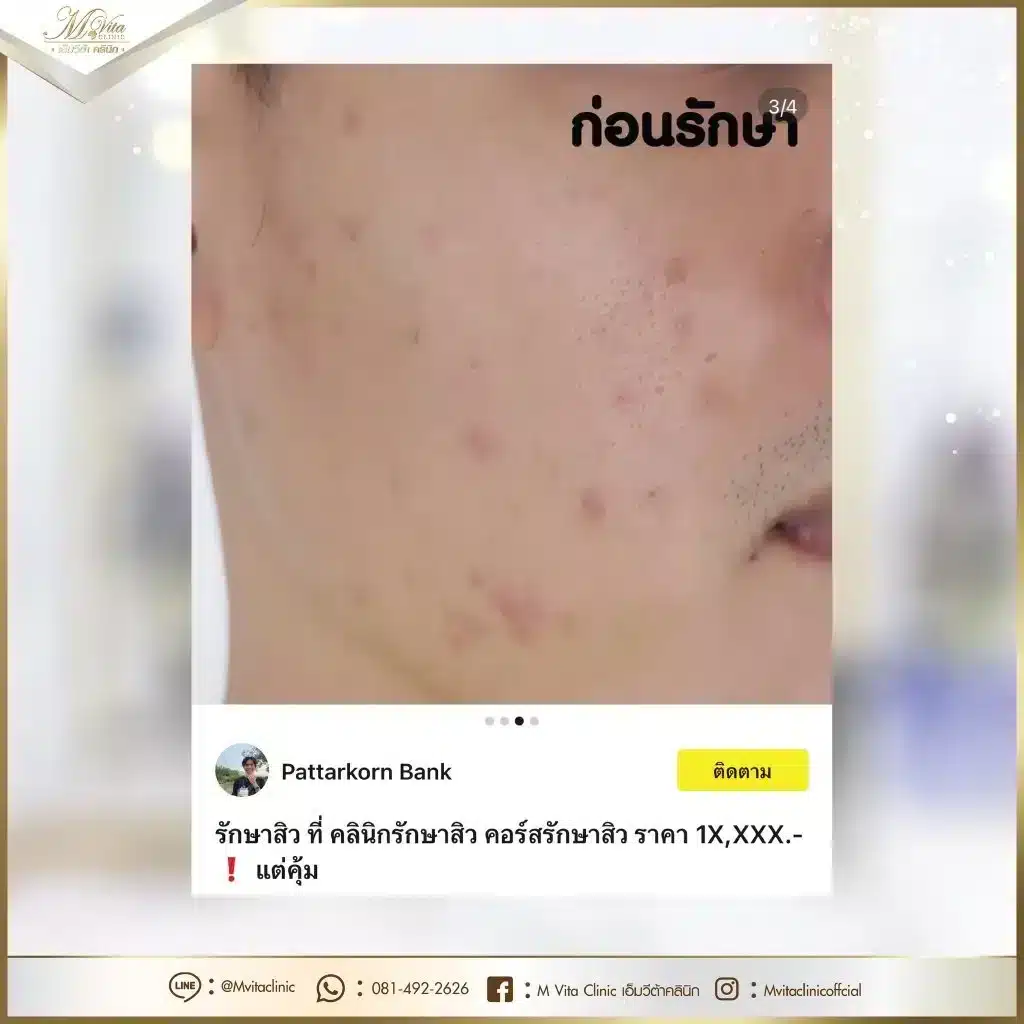 รีวิว-รักษาสิว-2-1024x1024