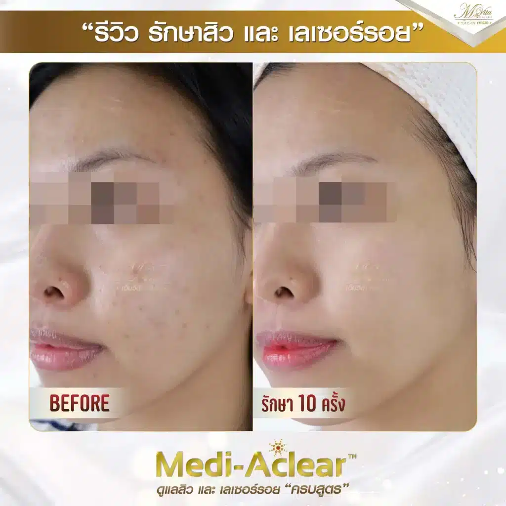 รีวิว-รักษาสิวและรอย-คุณมัช-1-01-1-1024x1024-1.webp
