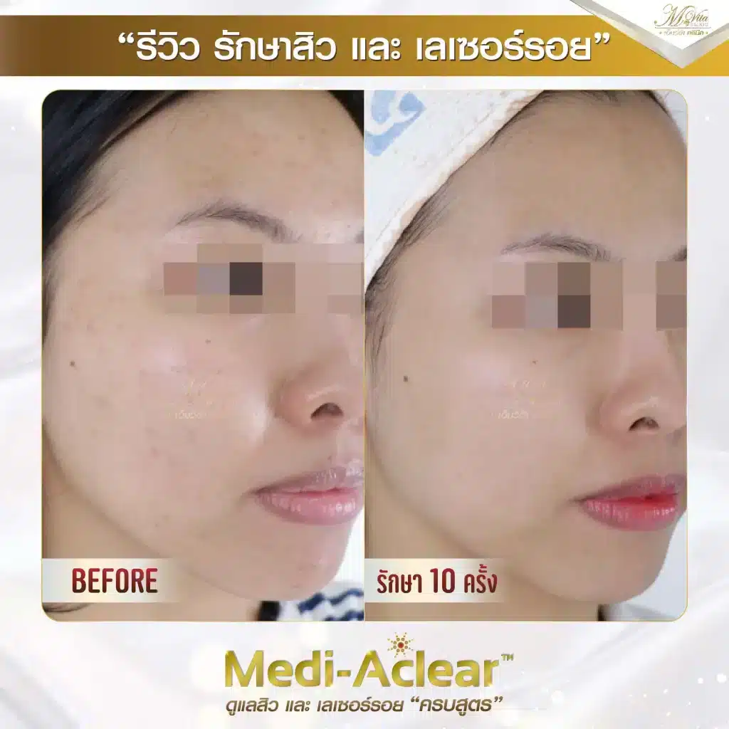รีวิว-รักษาสิวและรอย-คุณมัช-2-01-1-1024x1024-1.webp