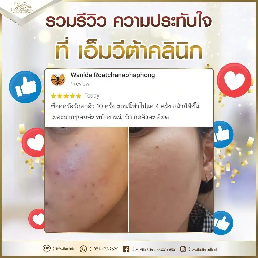 รีวิว-เอ็มวีต้า-คลินิก-7-1024x1024