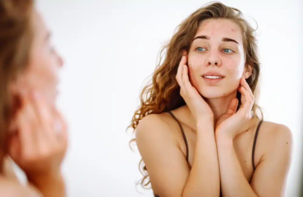 ข้อดี-ข้อเสีย ของการทำเลเซอร์สิว