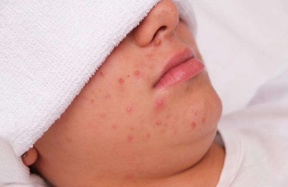 รักษาสิว ที่ M Vita Clinic