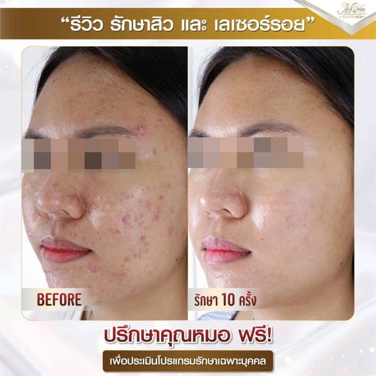 รีวิว รักษาสิวและรอย ครีม 1-01