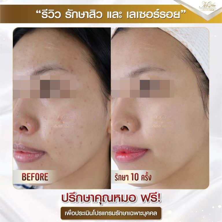 รีวิว รักษาสิวและรอย คุณมัช 1-01