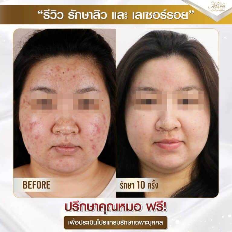 รีวิว หลุมสิว
