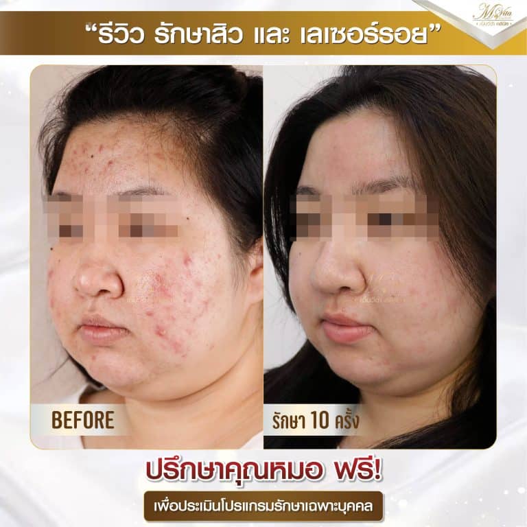 รีวิว รักษาสิวและรอย 2-01