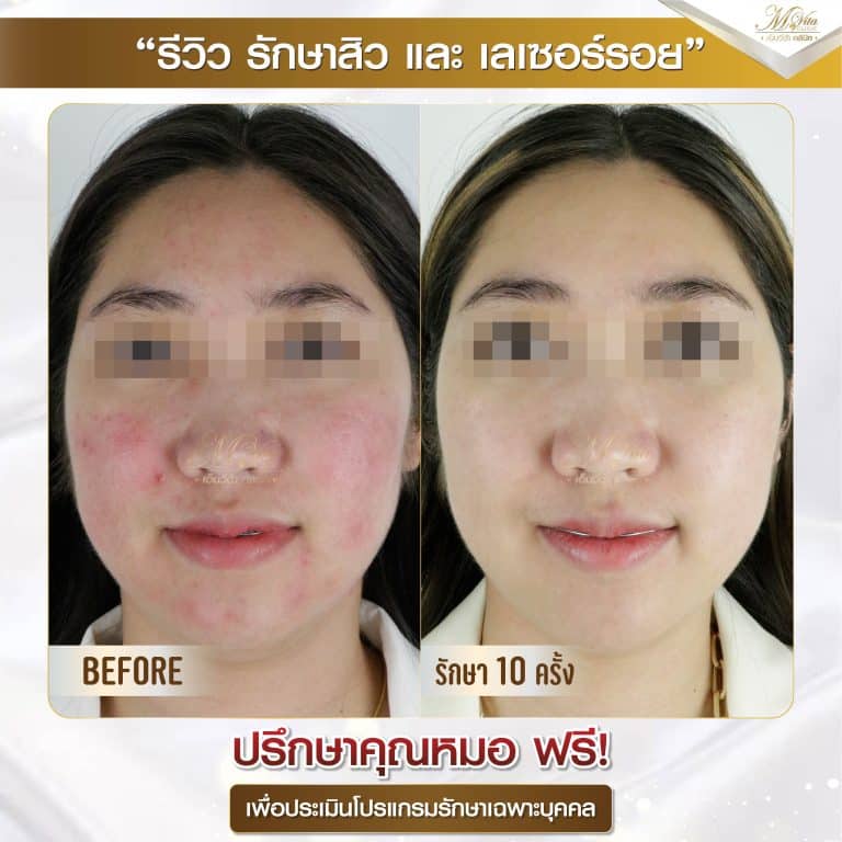 รีวิว รักษาสิวและรอย A-01