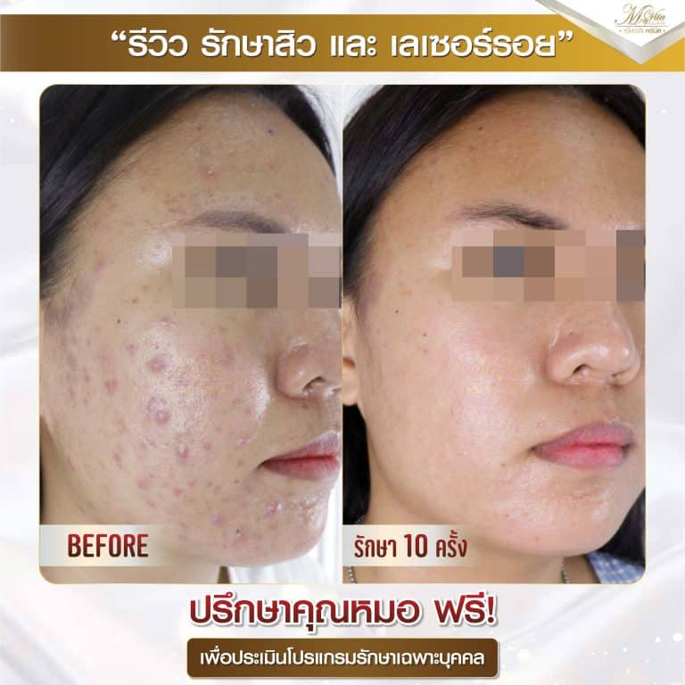 รีวิว รักษาสิวและรอย ครีม 2-01