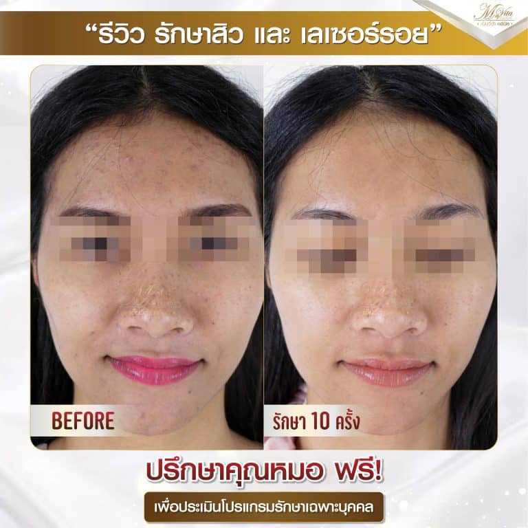 รีวิว รักษาสิวและรอย คุณต๋อม-01 (1)