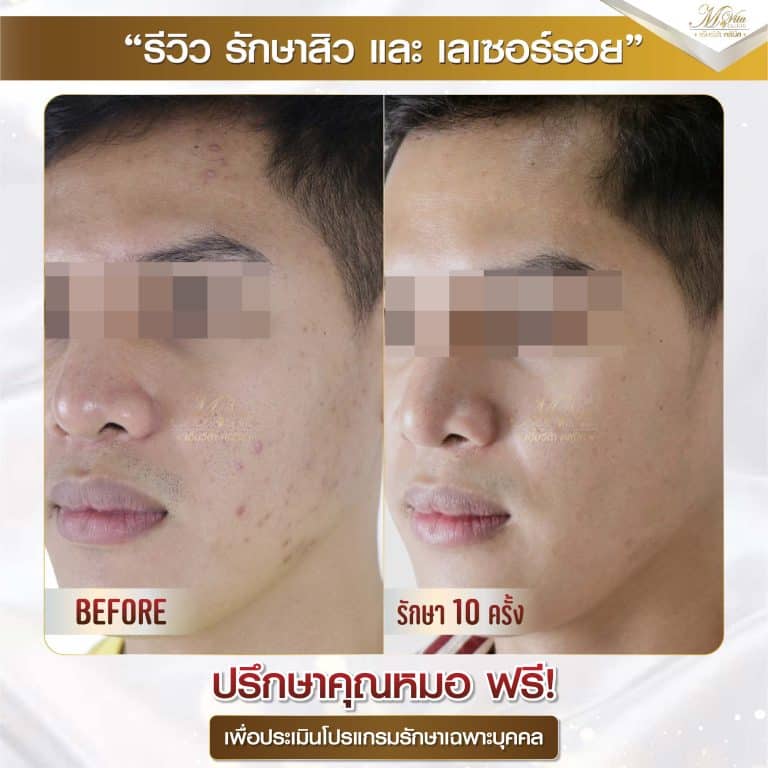 รีวิว รักษาสิวและรอย คุณนัท 1-01