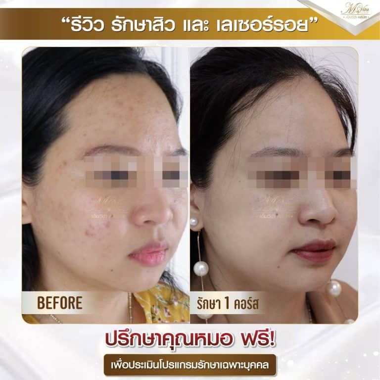 รีวิว รักษาสิวและรอย คุณริน-01 (1)