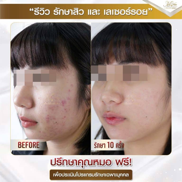 รีวิว รักษาสิวและรอย คุณอาย-01