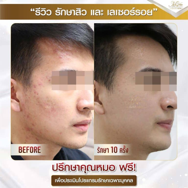 รีวิว รักษาสิวและรอย คุณฮิมjpg-01