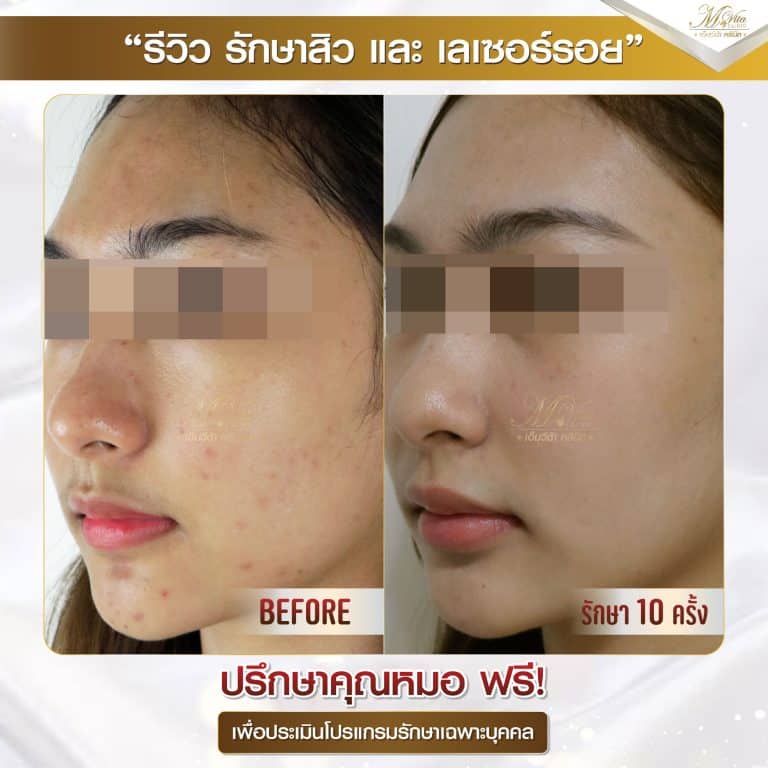 รีวิว รักษาสิวและรอย