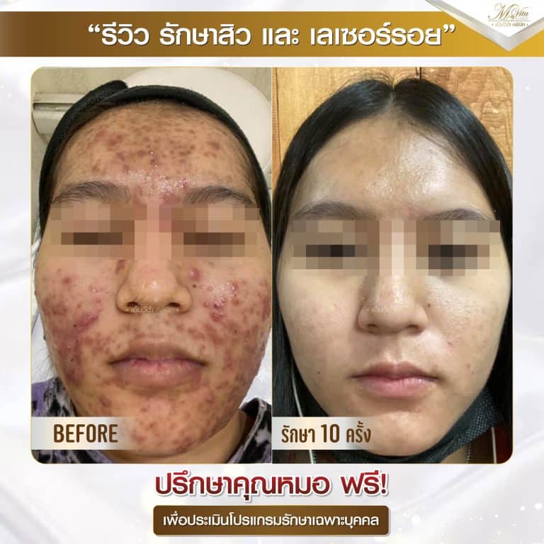 รีวิว หลุมสิว