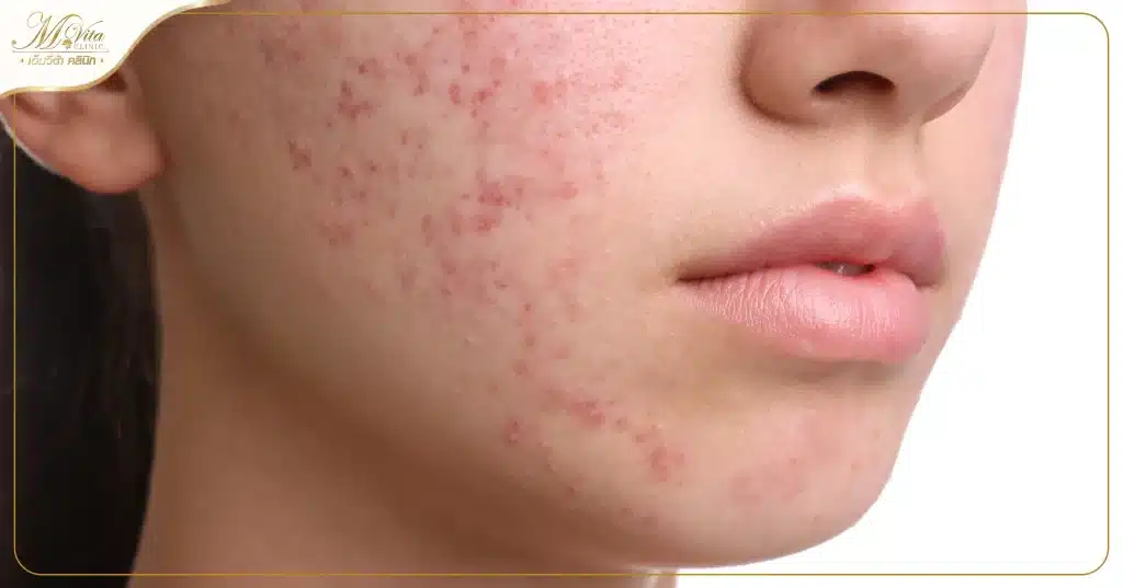การออกฤทธิ์ของ isotretinoin