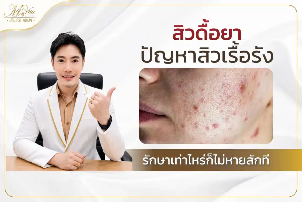 สิวดื้อยา