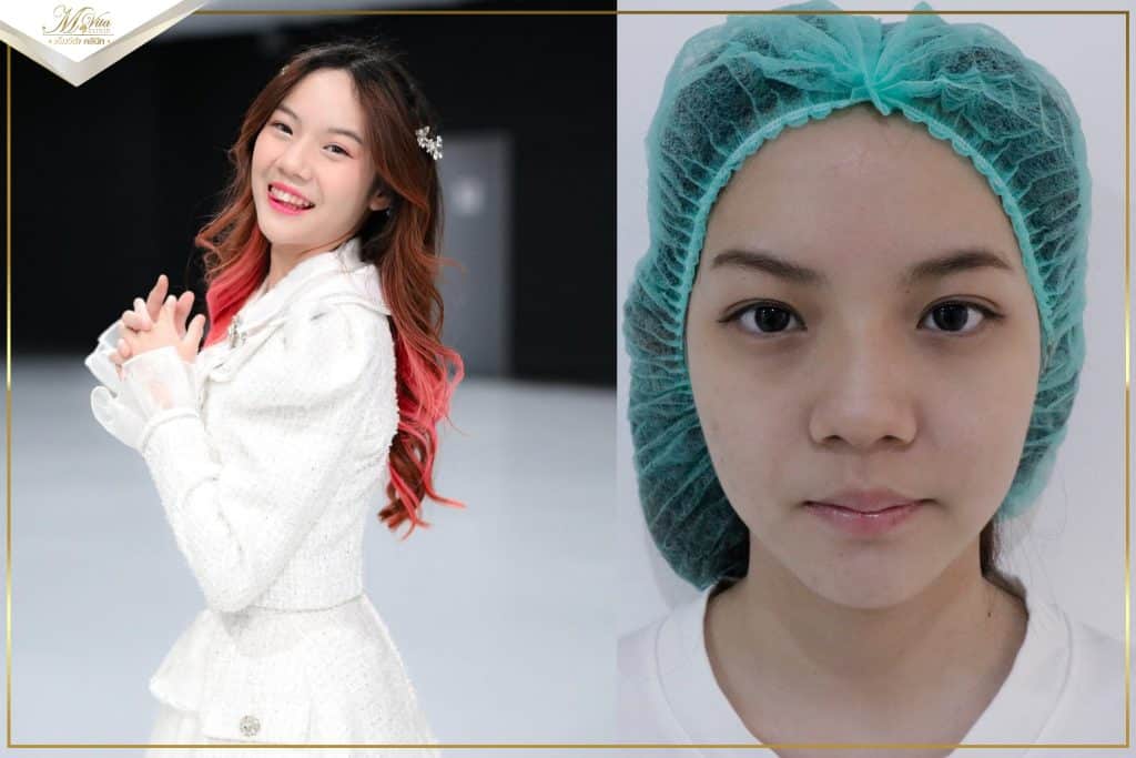 รีวิวรักษาสิว น้องซัทจัง BNK48ที่mvita Clinic