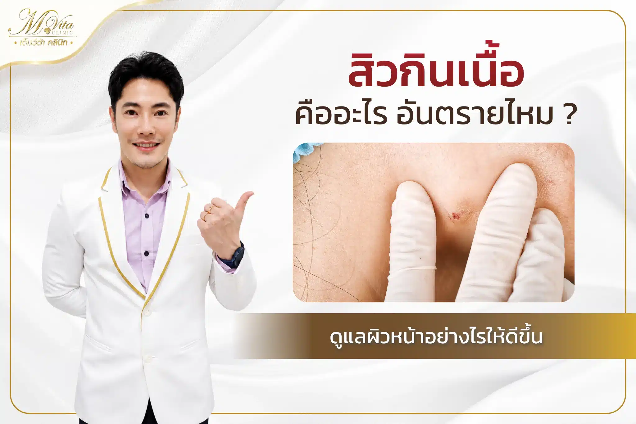 สิวกินเนื้อ