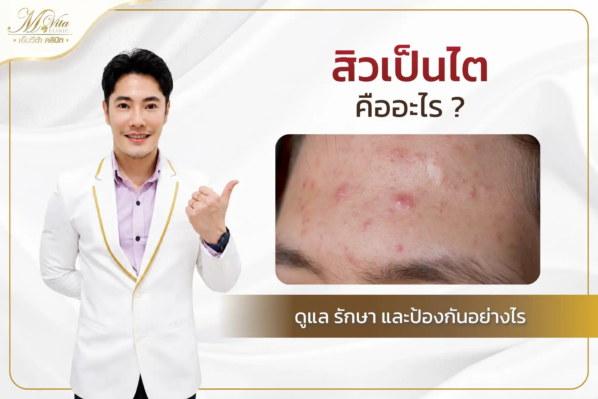 สิวเป็นไต