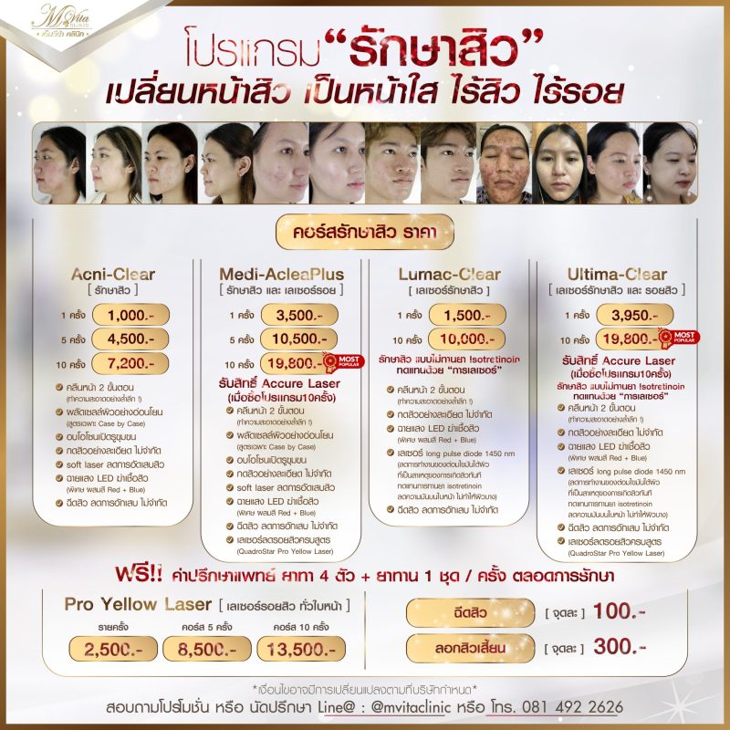 รักษาสิว ราคา
